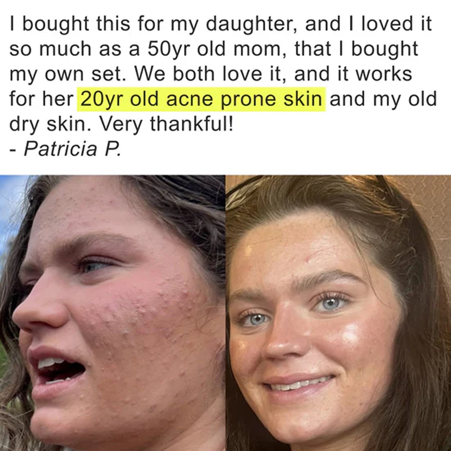 Before and after face photos with a mother-daughter testimonial about Pimple Scars Balm 2.0