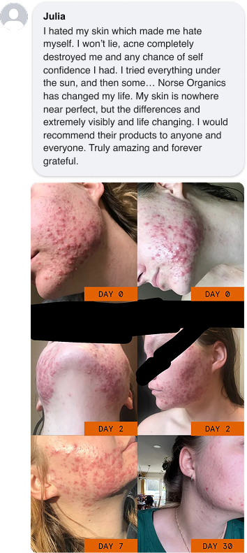 <p>Severe Acne Fixed <em>in Weeks</em></p>