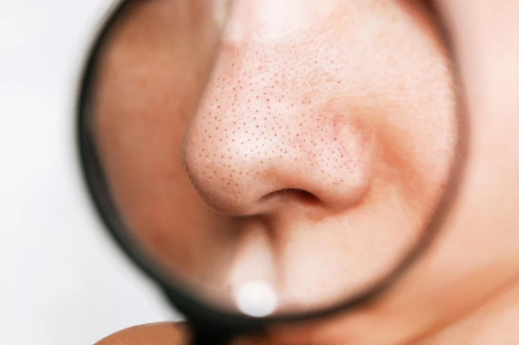 How to Remove a Blackhead