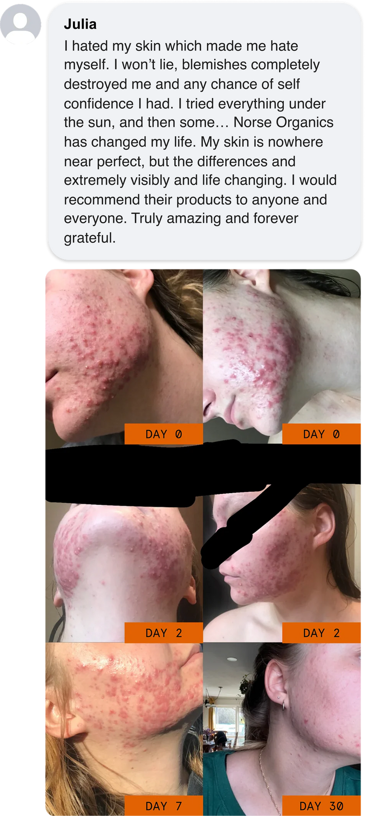<p>Severe Acne Fixed <em>in Weeks</em></p>