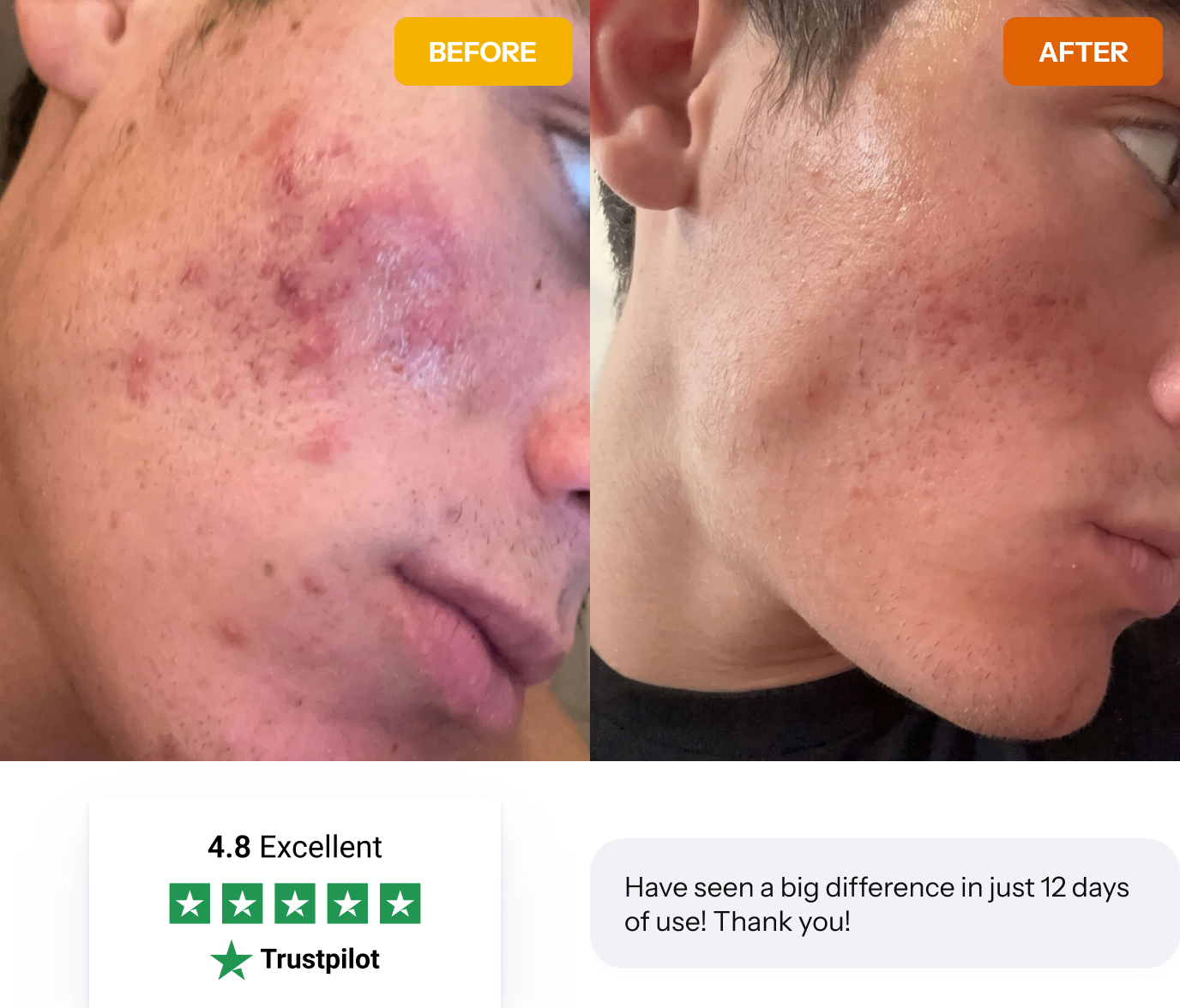 acne scars before and after results