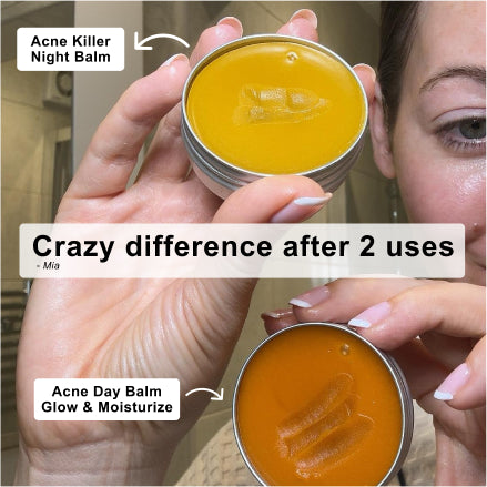 Hands holding open Acne Stopper Starter Pack day and night balms with a customer testimonial