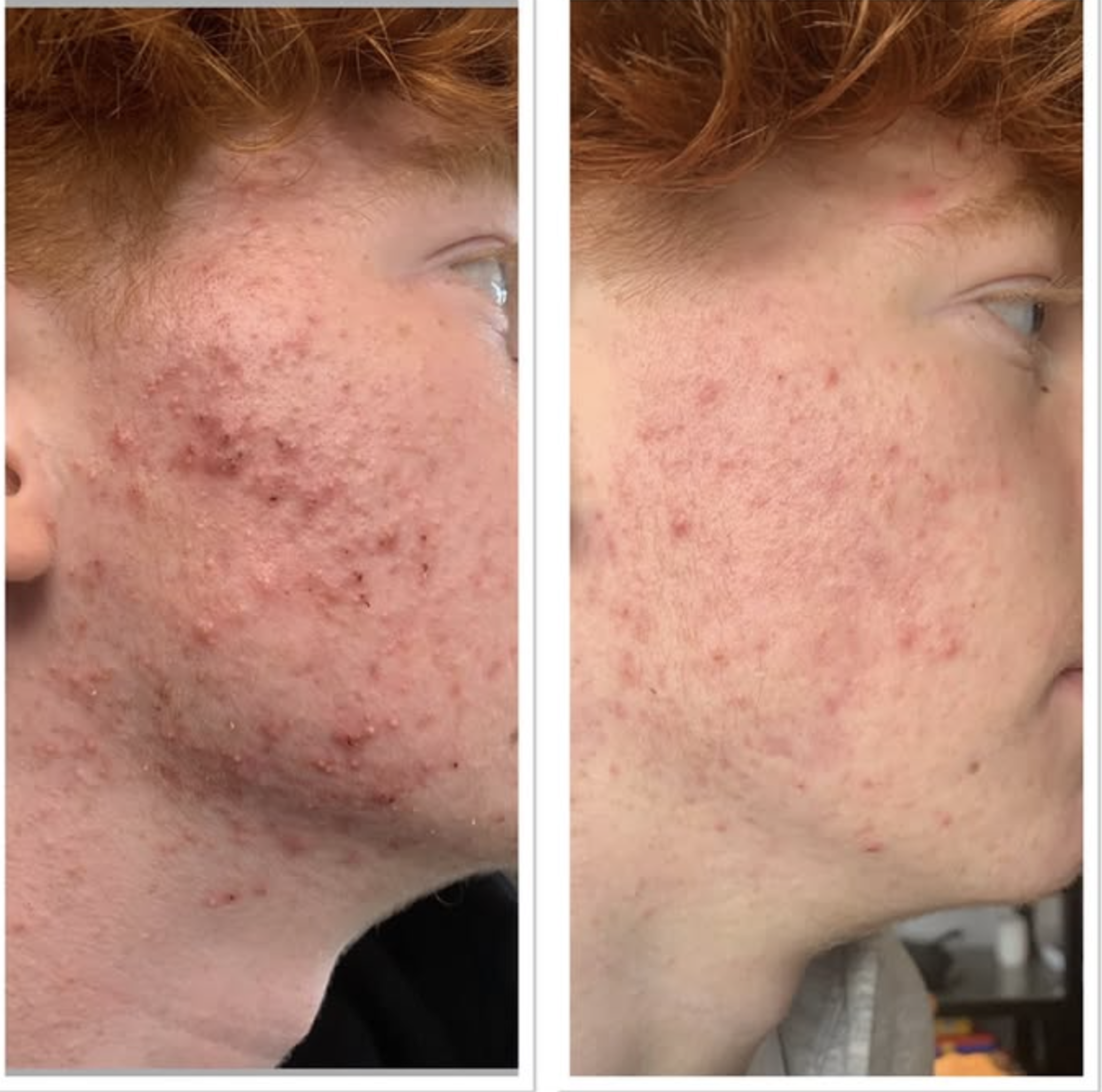 Post Acne Marks