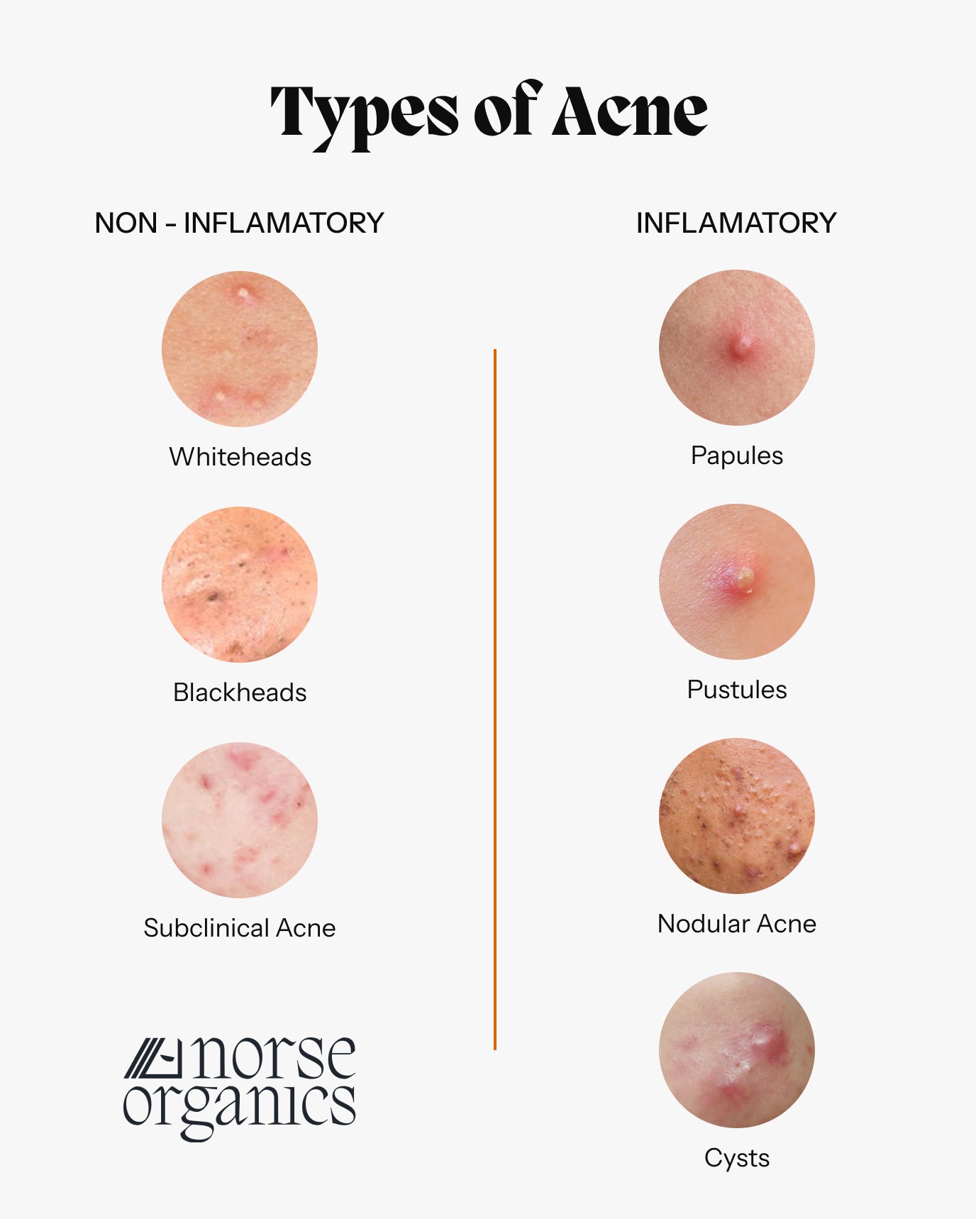 Norse Organics infographic comparing non-inflammatory and inflammatory acne types