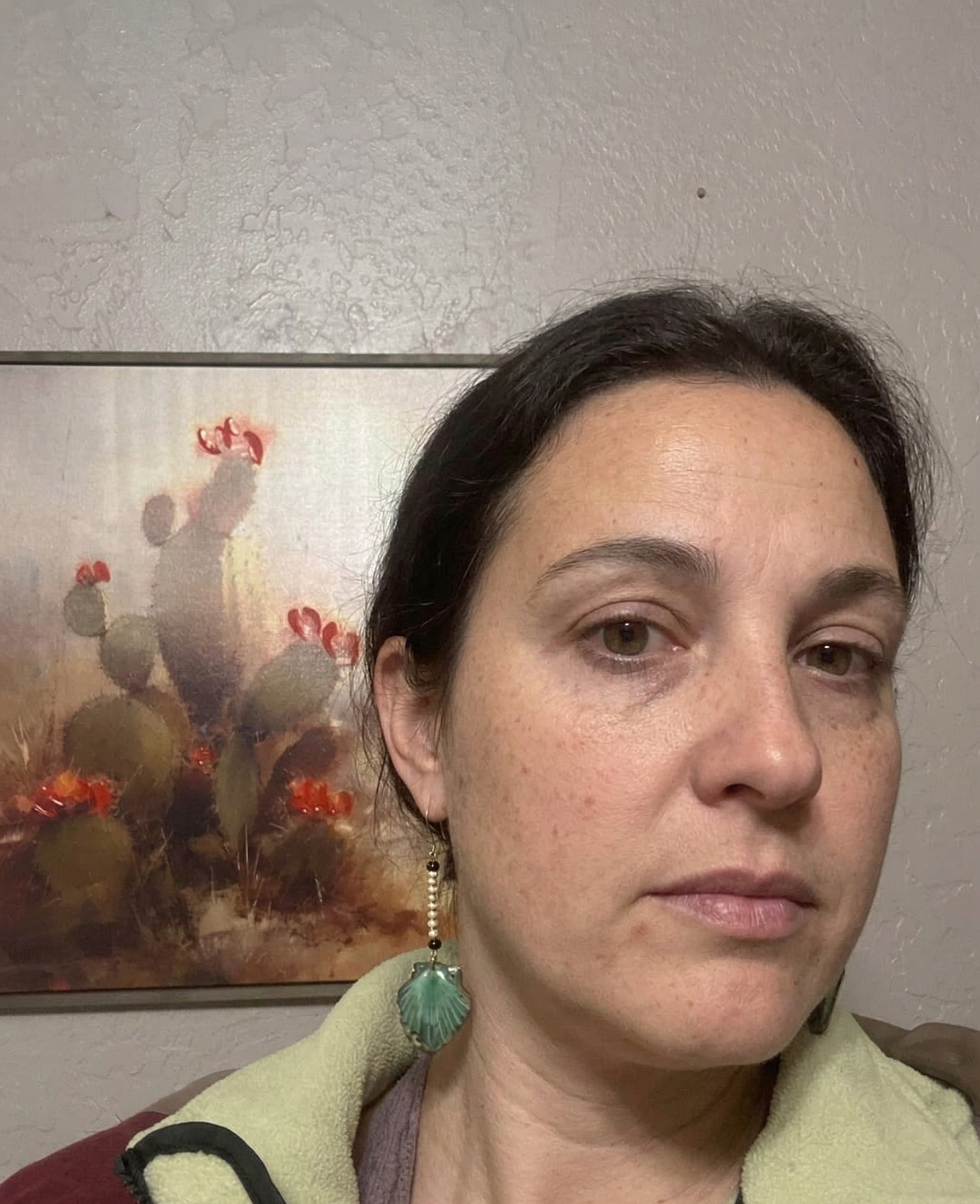 No-makeup selfie of a woman's bare, acne-prone face